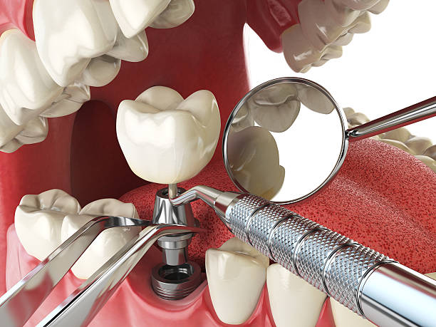Best Emergency Tooth Extraction in Inwood, WV